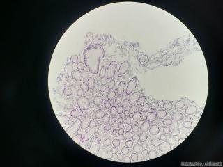 结肠取活检，请问息肉还是腺瘤？图10