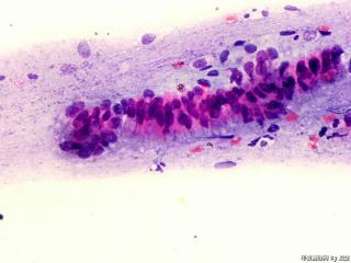 宫颈癌筛查图4