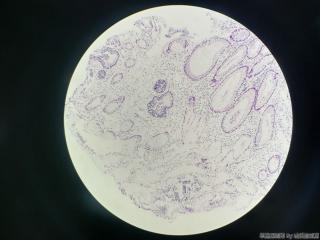 结肠取活检，请问息肉还是腺瘤？图8