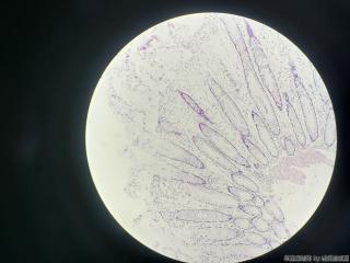 结肠取活检，请问息肉还是腺瘤？图4