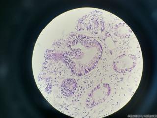 结肠取活检，请问息肉还是腺瘤？图11