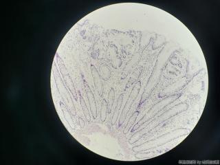 结肠取活检，请问息肉还是腺瘤？图3