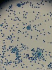 胸水细胞图2