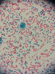 胸水细胞图9