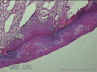 直肠粘膜息肉图14