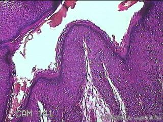 直肠粘膜息肉图3