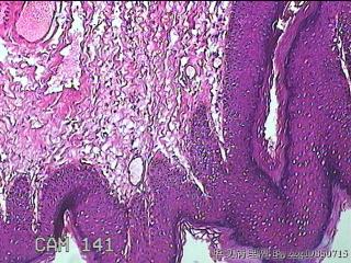 直肠粘膜息肉图5