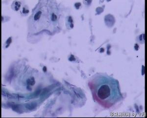 41岁，宫颈液基（今年春季查HPV高危阴性）图11