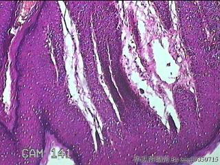 直肠粘膜息肉图2