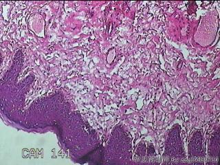 直肠粘膜息肉图6