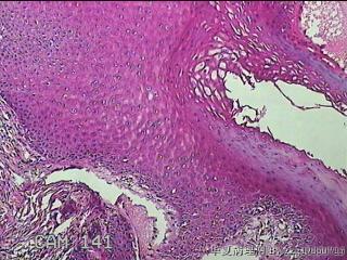 直肠粘膜息肉图16