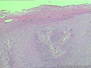 外阴粘膜白斑--单纯性苔藓？图6