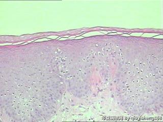 外阴粘膜白斑--单纯性苔藓？图3