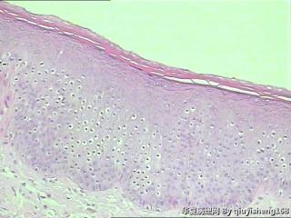 外阴粘膜白斑--单纯性苔藓？图4