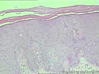外阴粘膜白斑--单纯性苔藓？图2