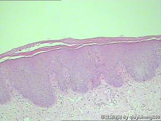 外阴粘膜白斑--单纯性苔藓？图1