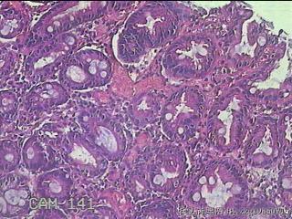 胃窦粘膜图15