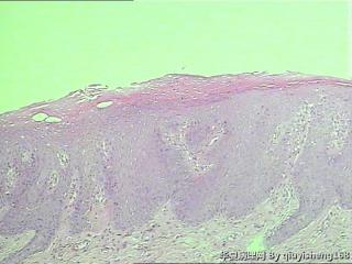 外阴粘膜白斑--单纯性苔藓？图5