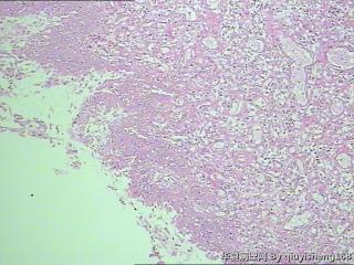 宫颈赘生物--息肉坏死吗？算是哪种类型的呢图5