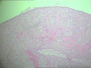 宫颈赘生物--息肉坏死吗？算是哪种类型的呢图1