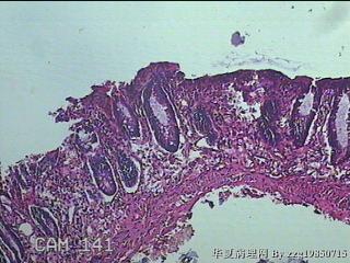 直肠下段粘膜图14