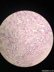 畸胎瘤的囊壁，大量腺腔结构，考虑什么？图15