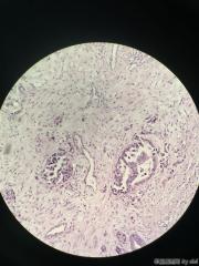 畸胎瘤的囊壁，大量腺腔结构，考虑什么？图14