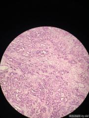 畸胎瘤的囊壁，大量腺腔结构，考虑什么？图8