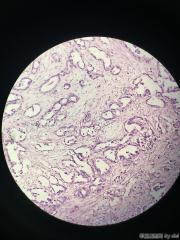 畸胎瘤的囊壁，大量腺腔结构，考虑什么？图16