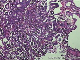 胃窦小弯侧粘膜图5
