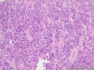 子宫肌间瘤结节(瘤细胞密集，围绕血管分布，血管丰富伴透明变性）图12