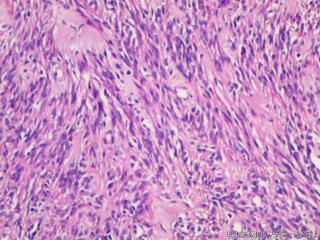 子宫肌间瘤结节(瘤细胞密集，围绕血管分布，血管丰富伴透明变性）图18