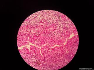 子宫内膜，这是腺上皮嗜酸性化生？请路过的老师帮看看图3