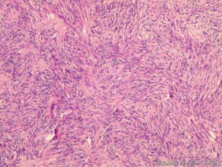 子宫肌间瘤结节(瘤细胞密集，围绕血管分布，血管丰富伴透明变性）图25