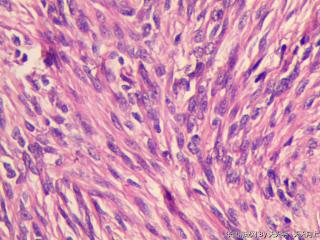 子宫肌间瘤结节(瘤细胞密集，围绕血管分布，血管丰富伴透明变性）图27