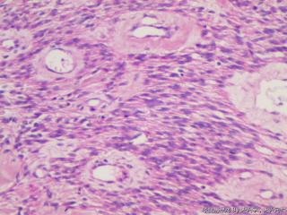 子宫肌间瘤结节(瘤细胞密集，围绕血管分布，血管丰富伴透明变性）图15