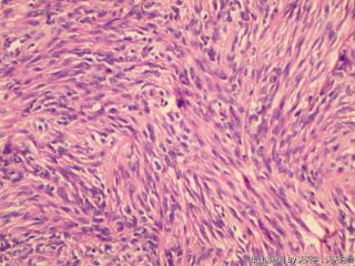 子宫肌间瘤结节(瘤细胞密集，围绕血管分布，血管丰富伴透明变性）图26