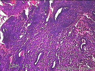 宫腔内组织图47