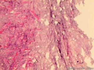 子宫肌间瘤结节(瘤细胞密集，围绕血管分布，血管丰富伴透明变性）图19