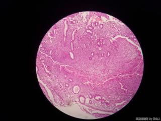 子宫内膜，这是腺上皮嗜酸性化生？请路过的老师帮看看图2