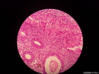 子宫内膜，这是腺上皮嗜酸性化生？请路过的老师帮看看图4