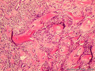 子宫肌间瘤结节(瘤细胞密集，围绕血管分布，血管丰富伴透明变性）图20
