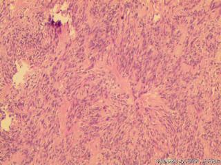 子宫肌间瘤结节(瘤细胞密集，围绕血管分布，血管丰富伴透明变性）图21