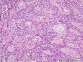 子宫肌间瘤结节(瘤细胞密集，围绕血管分布，血管丰富伴透明变性）图14