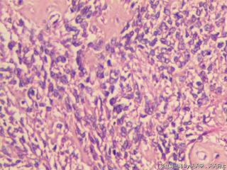 子宫肌间瘤结节(瘤细胞密集，围绕血管分布，血管丰富伴透明变性）图22