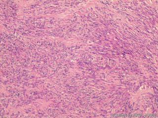 子宫肌间瘤结节(瘤细胞密集，围绕血管分布，血管丰富伴透明变性）图24