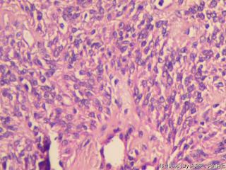 子宫肌间瘤结节(瘤细胞密集，围绕血管分布，血管丰富伴透明变性）图23