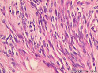 子宫肌间瘤结节(瘤细胞密集，围绕血管分布，血管丰富伴透明变性）图28