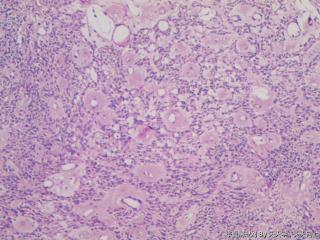 子宫肌间瘤结节(瘤细胞密集，围绕血管分布，血管丰富伴透明变性）图7