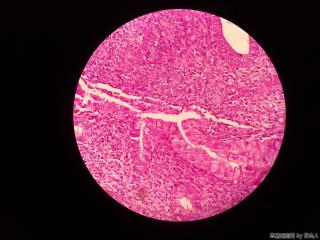 子宫内膜，这是腺上皮嗜酸性化生？请路过的老师帮看看图5